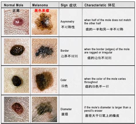 身上痣多|你身上的痣会癌变吗？医生分析了100多颗黑痣，快来对照下！